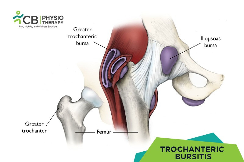 Top 5 Exercises For Trochanteric Bursitis