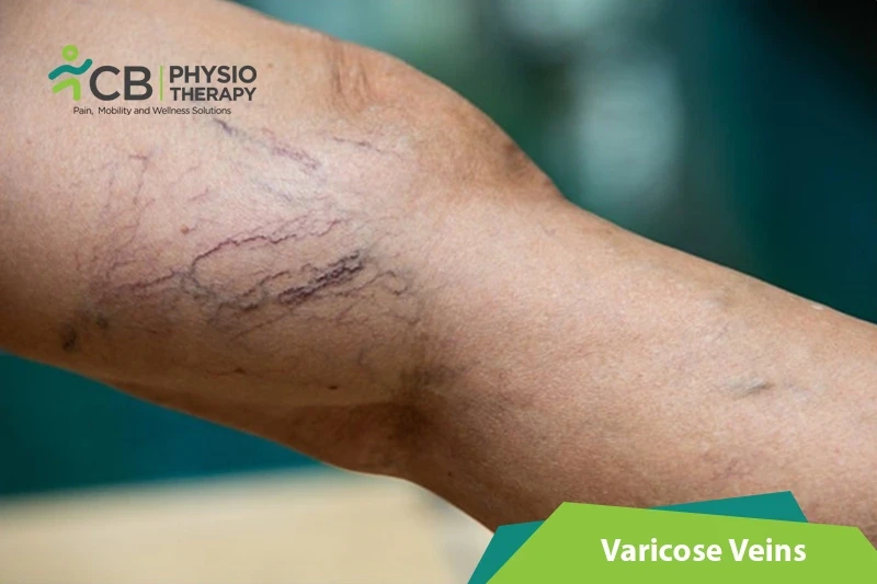 Top 5 Exercises For Varicose Veins