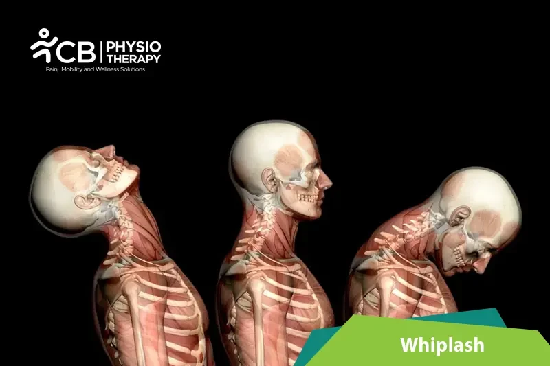 Top 5 Exercises For Whiplash