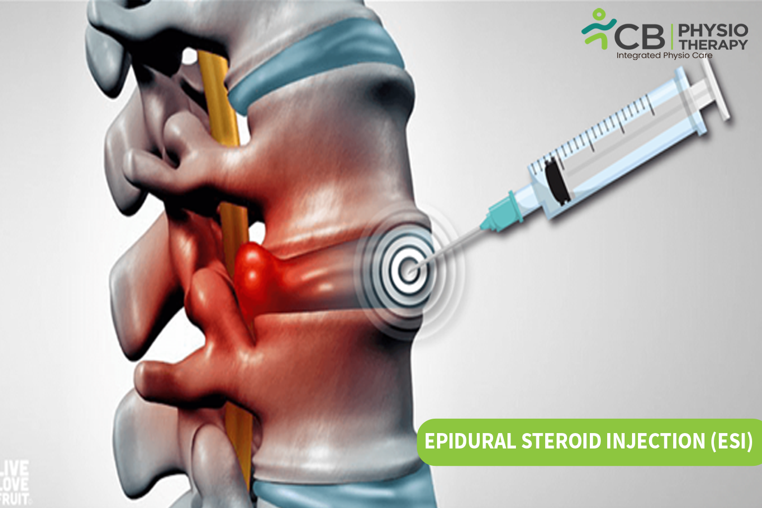 Epidural Steroid Injection (esi)