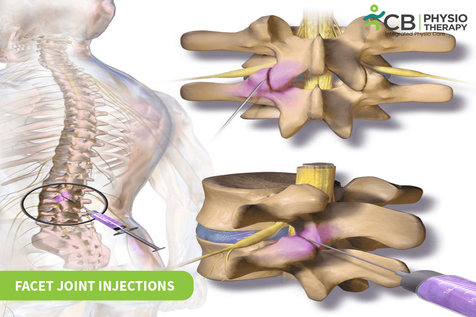 Facet Joint Injections
