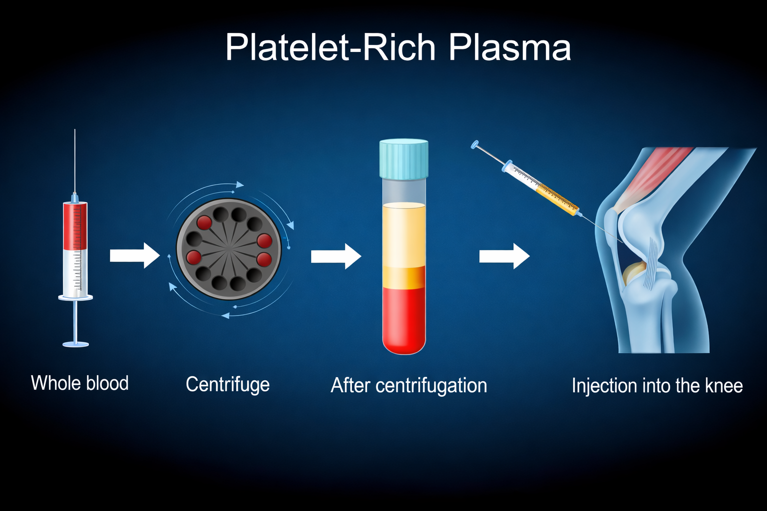 Platelet-rich Plasma (prp) Injections