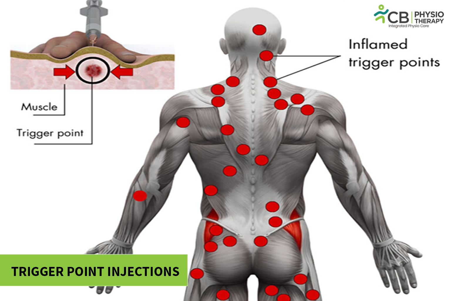Trigger Point Injection