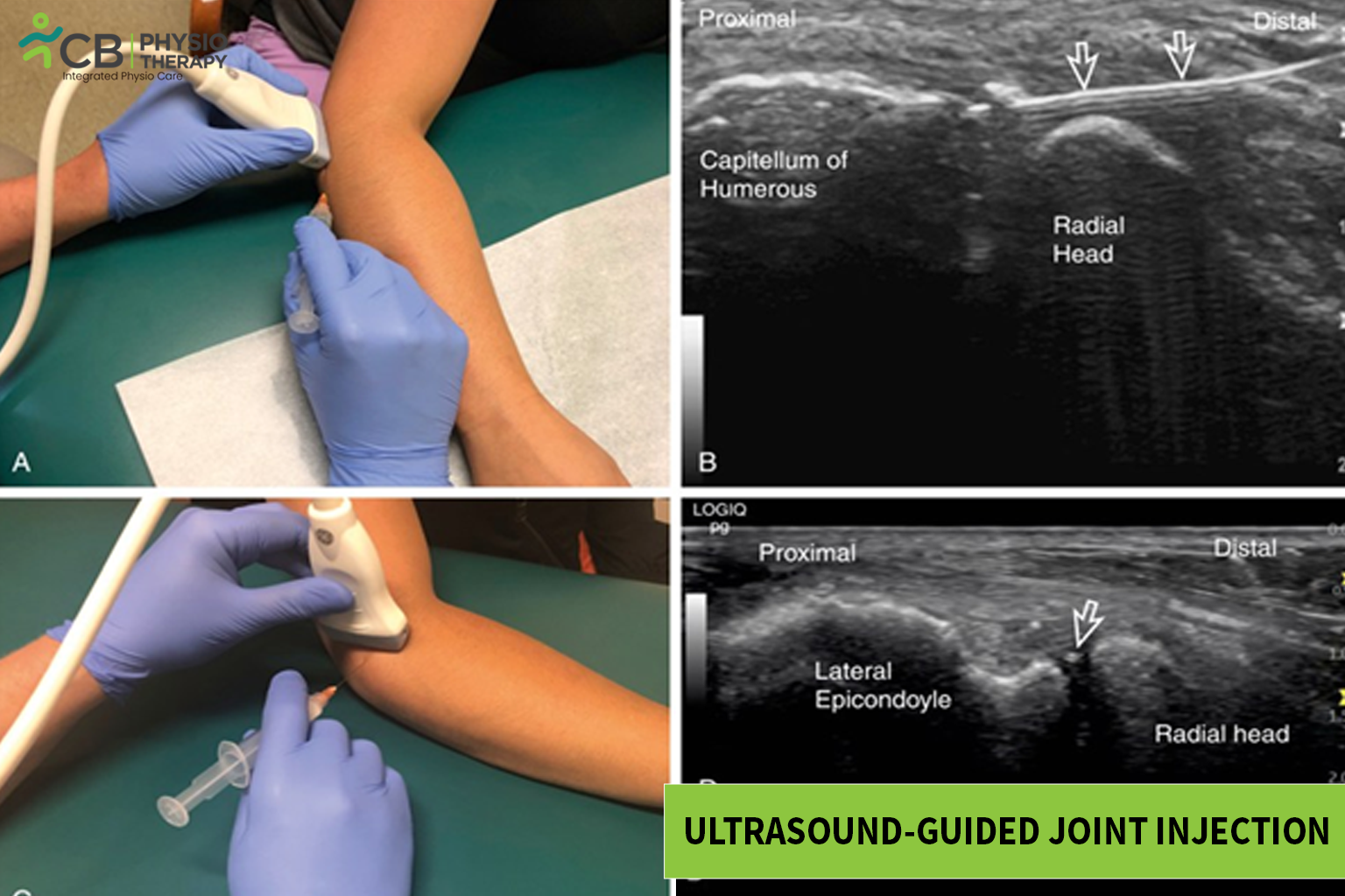 Ultrasound-guided Joint Injection